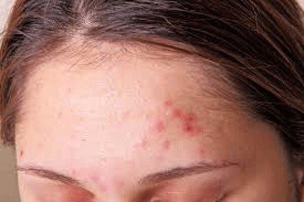ارتباط مصرف لبنیات و غذاهای چرب با بروز آکنه در بزرگسالان ارتباط مصرف لبنیات و غذاهای چرب با بروز آکنه در بزرگسالان